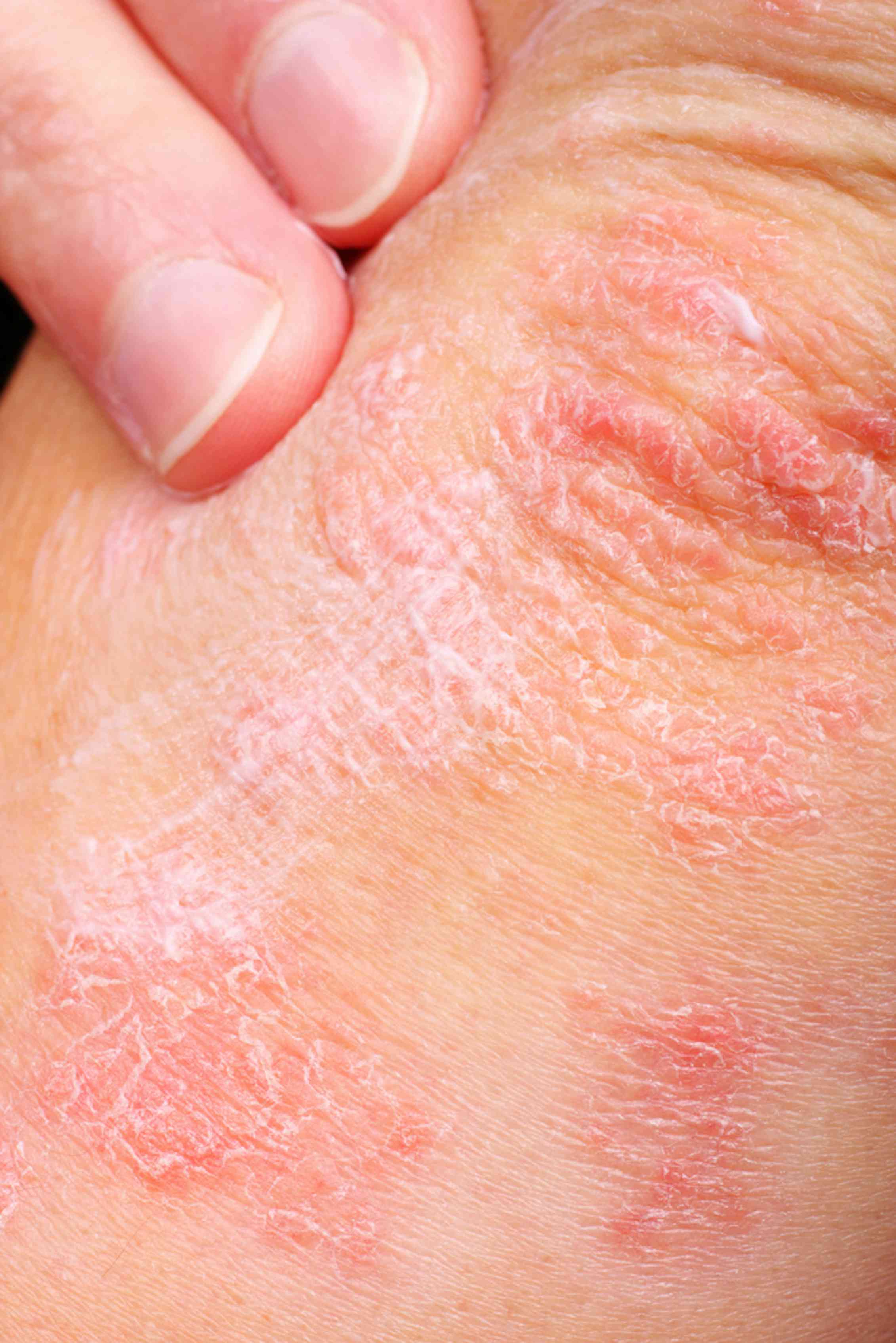 types of eczema