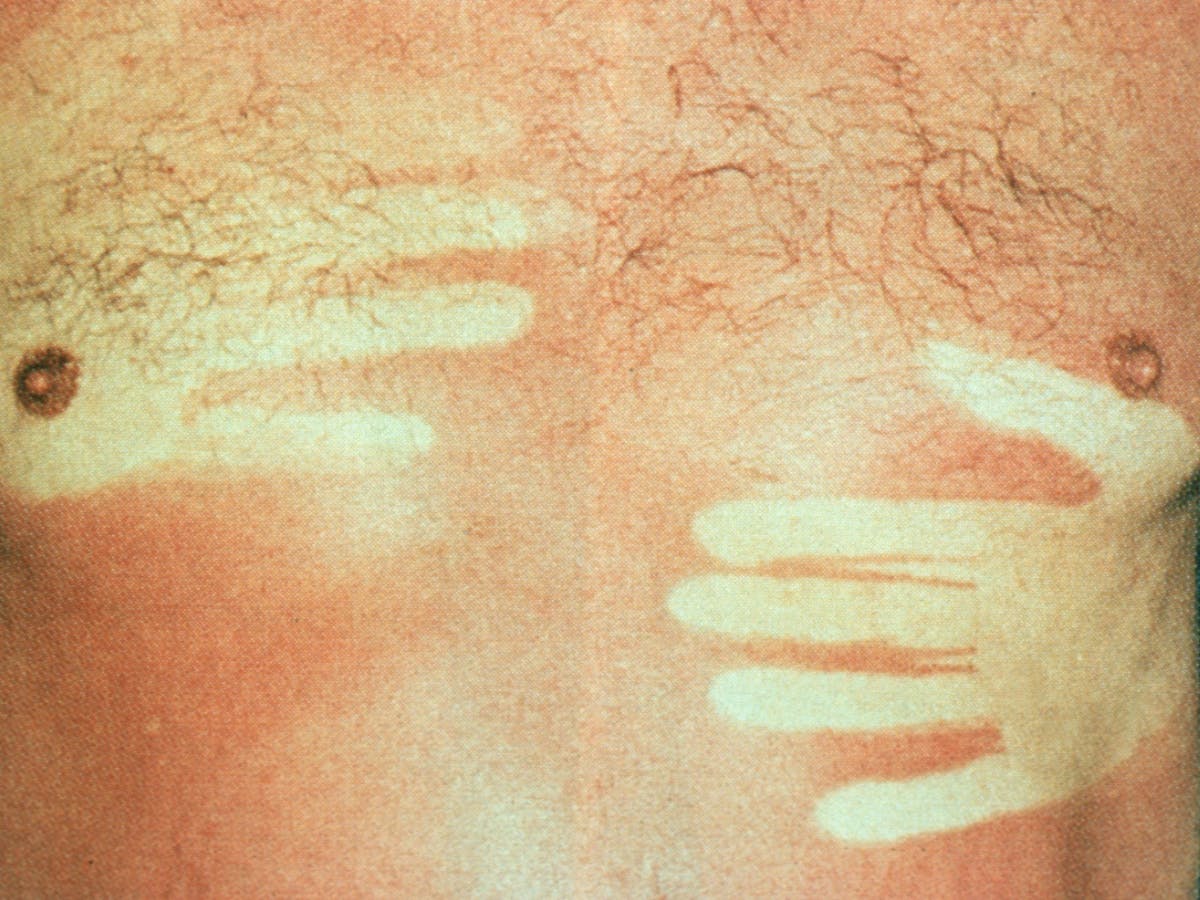 Explainer What Happens To Your Skin When You Get Sunburnt