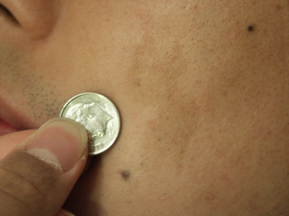 Explainer: what are birthmarks and why do we get them?