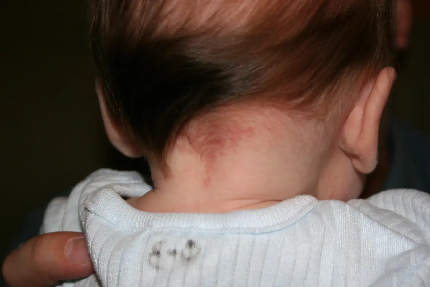 Explainer What Are Birthmarks And Why Do We Get Them