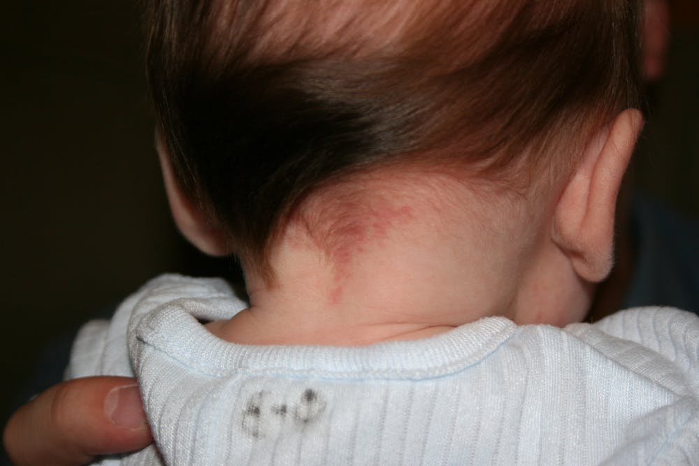 Explainer: what are birthmarks and why do we get them?