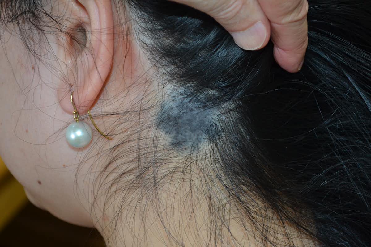 Explainer: what are birthmarks and why do we get them?