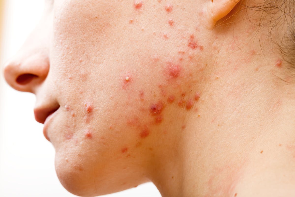 Acne treatment: antibiotics don't need to kill bacteria to clear up your  skin