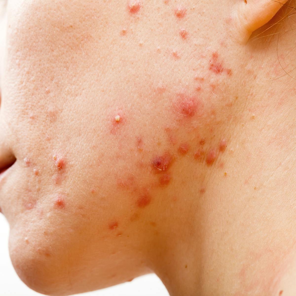 Acne treatment: antibiotics don't need to kill bacteria to clear up your  skin