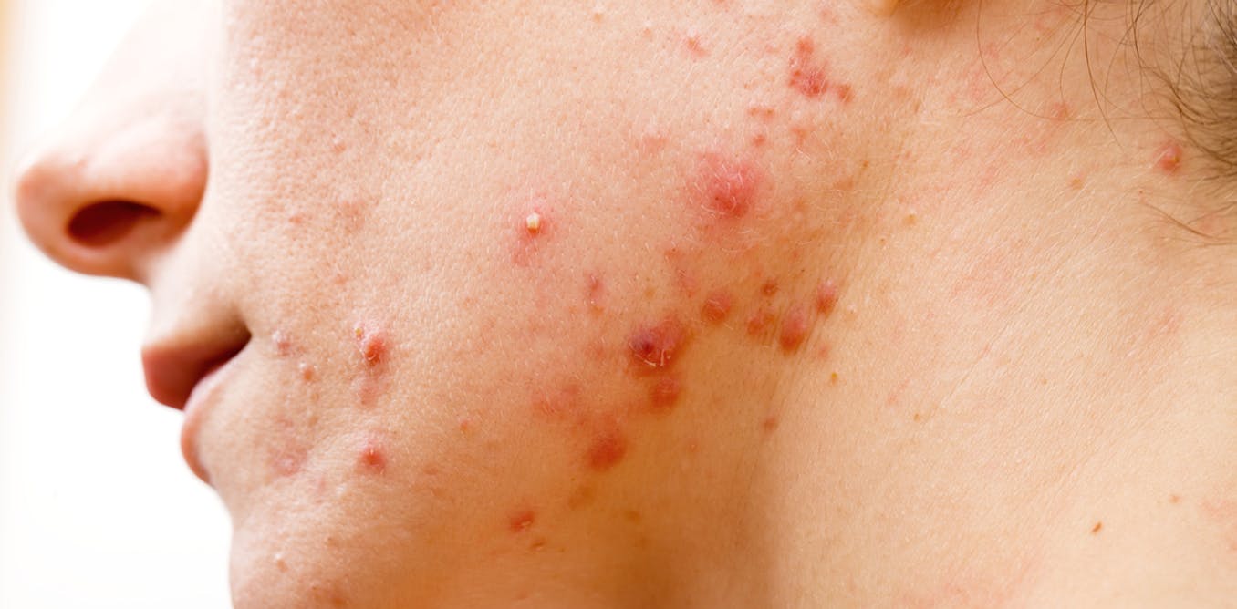 Acne treatment: antibiotics don’t need to kill bacteria to clear up your skin