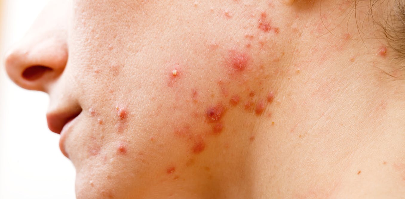 Acne treatment: antibiotics don't need to kill bacteria to clear up your skin