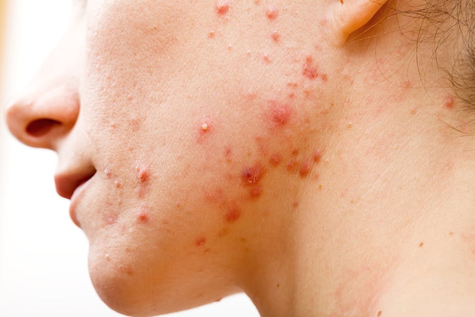 Acne treatment: antibiotics don't need to kill bacteria to clear up your skin