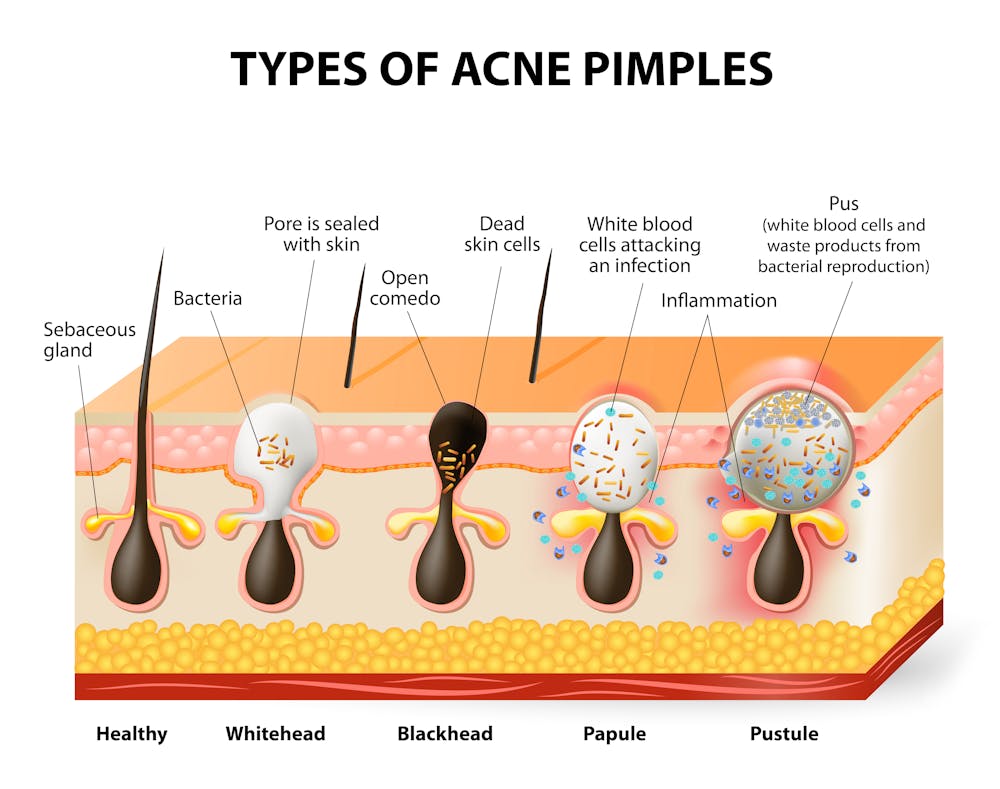 Image result for bacteria acne