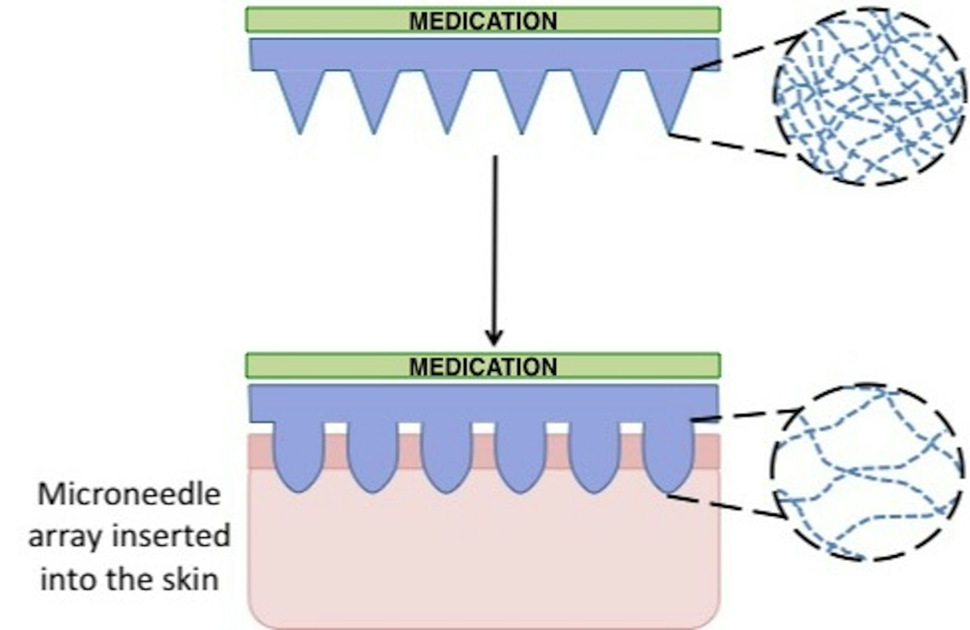 Explainer: What Are Microneedles And Why Do We Need Them?