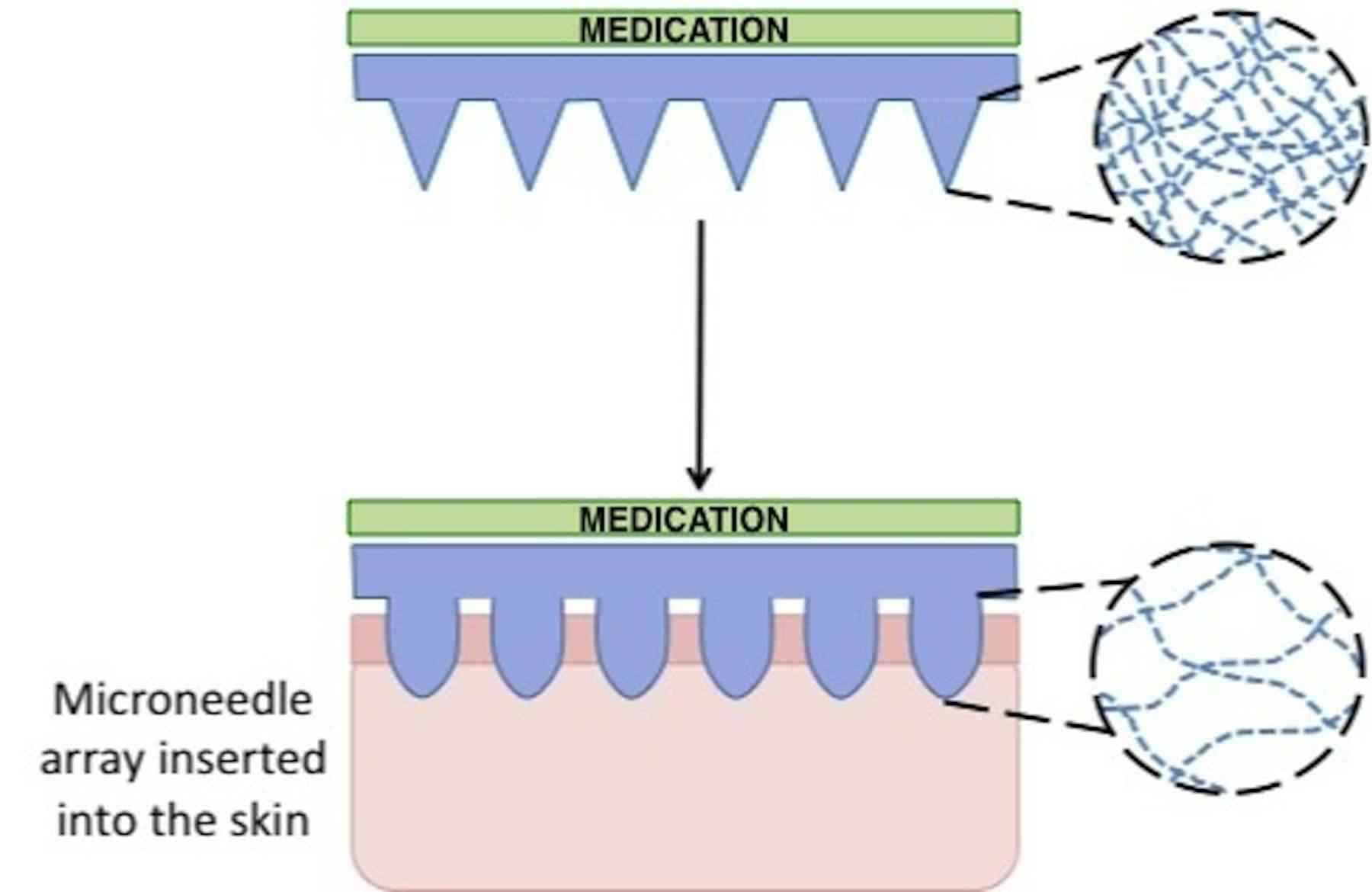 Explainer: what are microneedles and why do we need them?