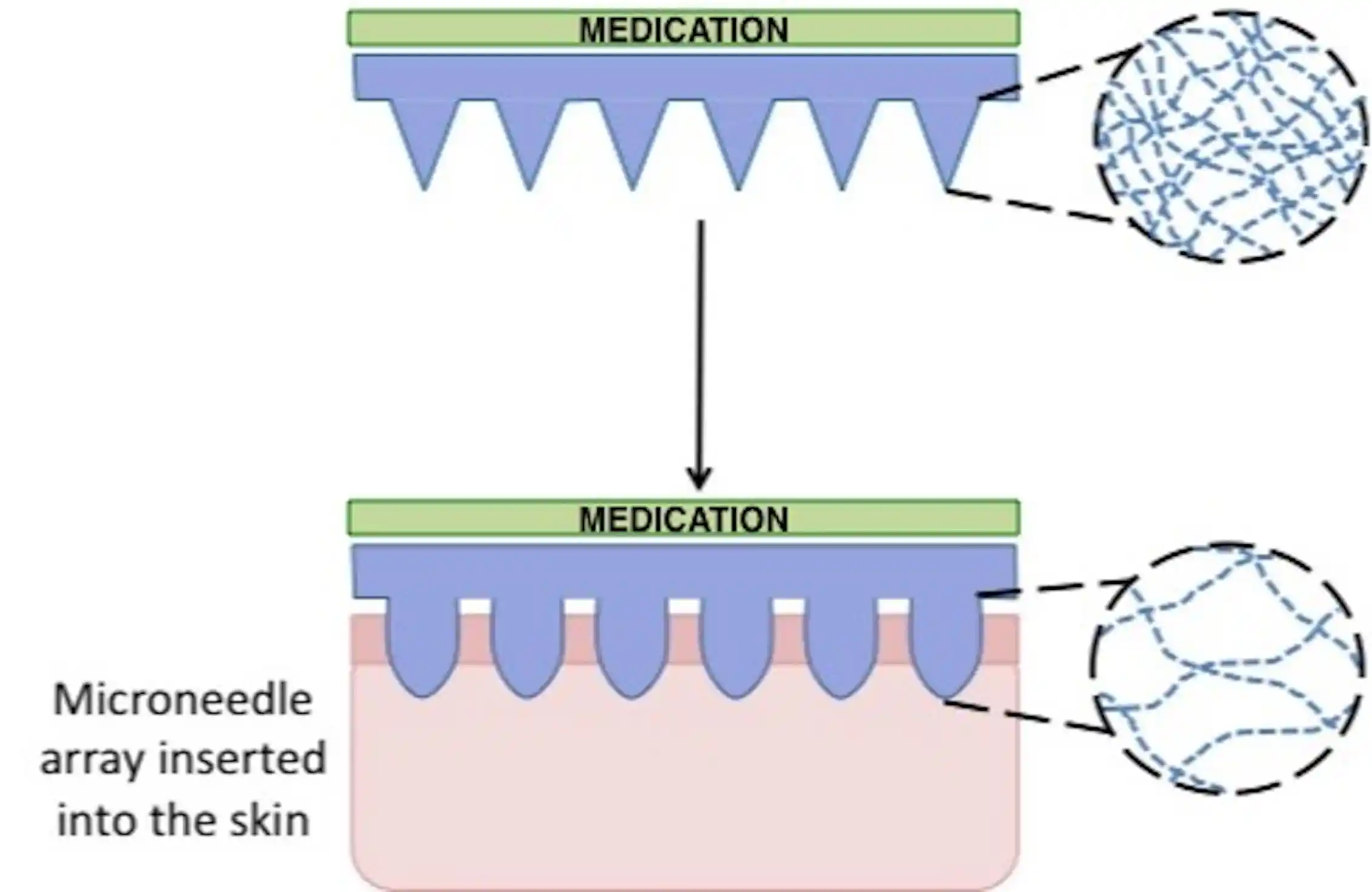 Explainer: what are microneedles and why do we need them? 0.25 microneedle