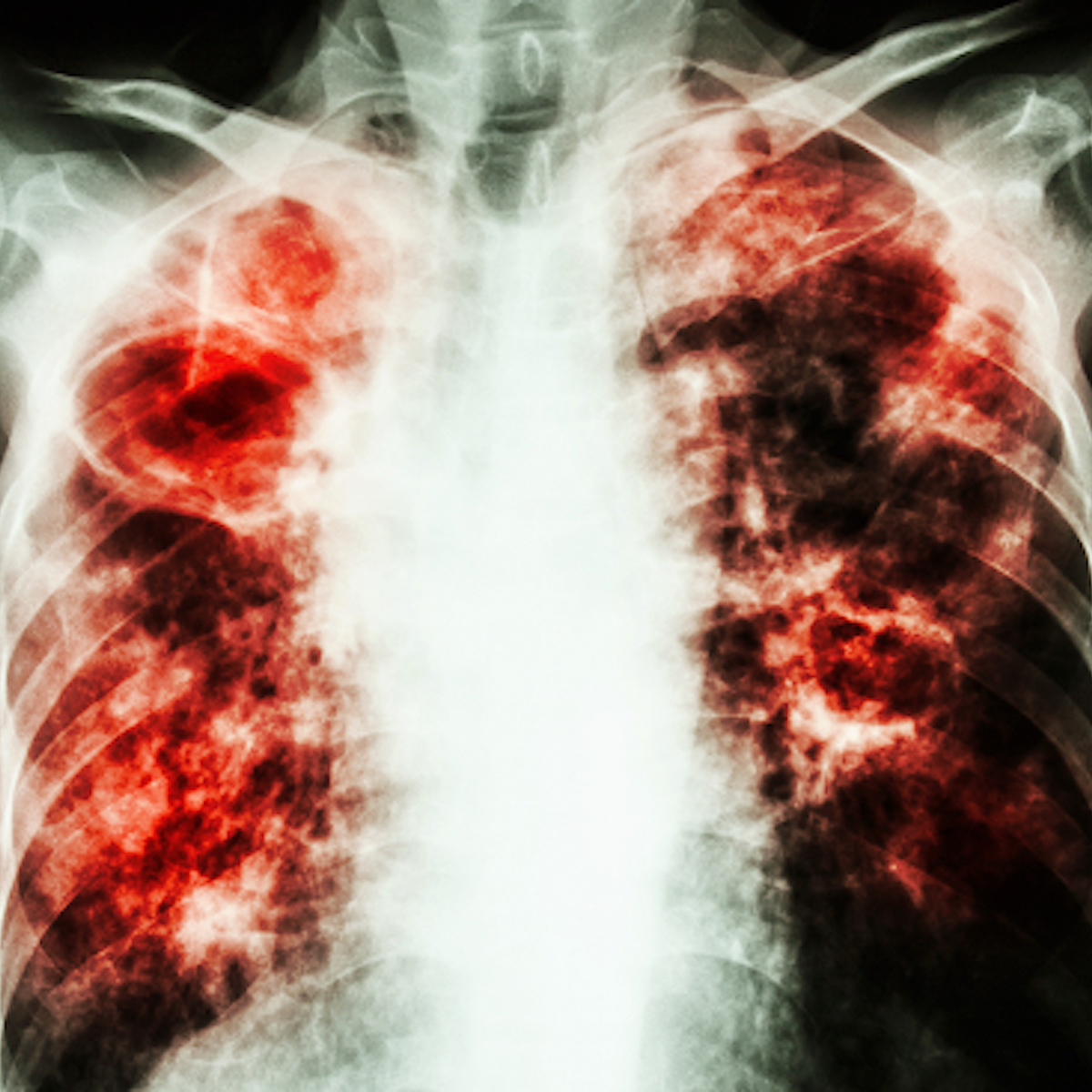 The Fight Against Tb Shifts To Fixing The Immune System Not Only Bacteria