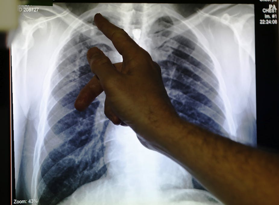 Tuberculosis Kills Thousands Of People Every Day We Aren T Doing Enough To Stop It