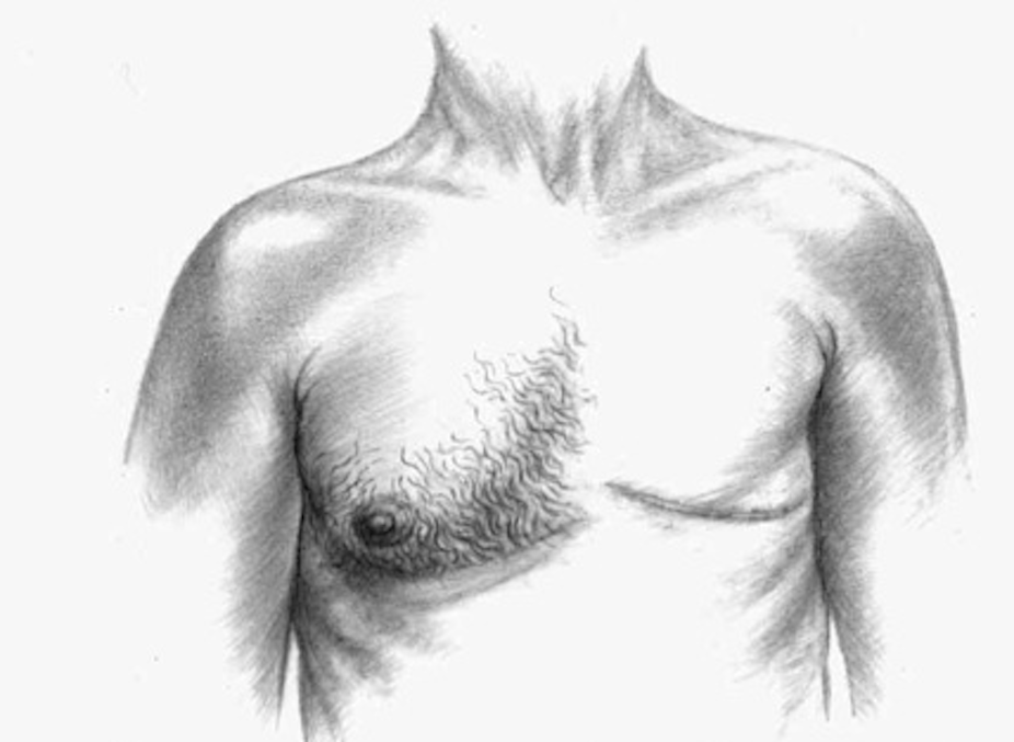 Breast cancer: Get it off your chest - Faculty of Health Sciences