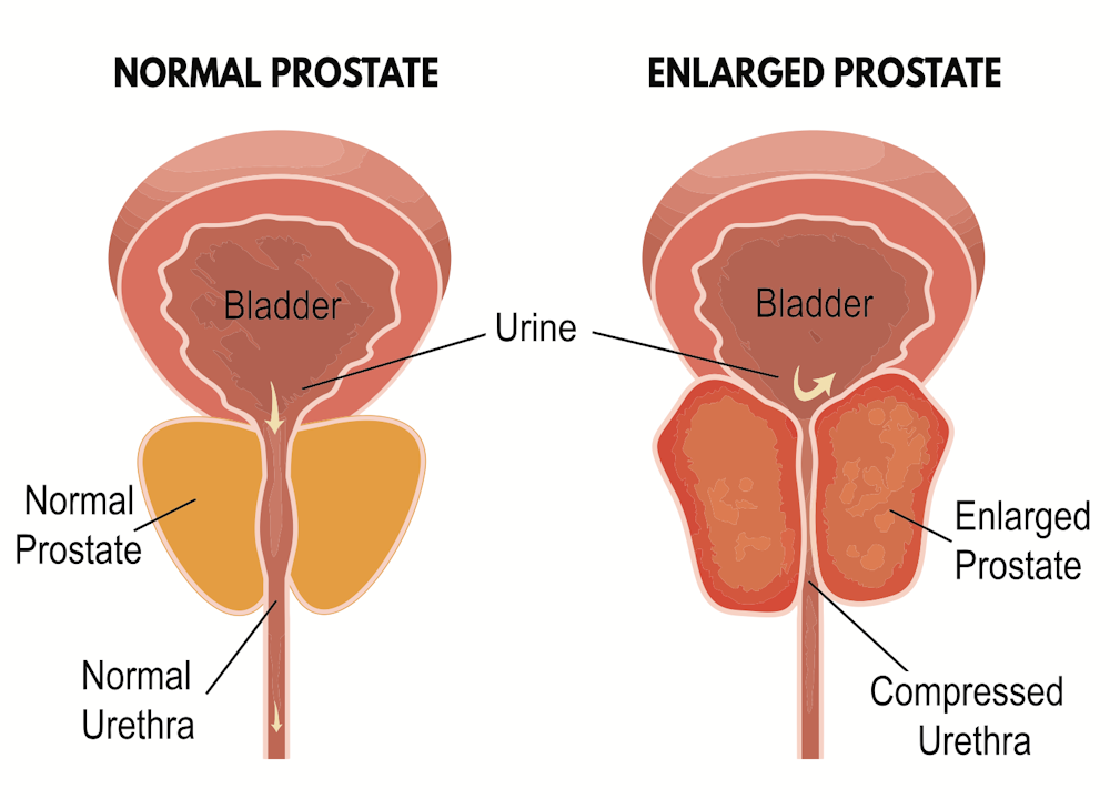 what causes enlarged prostate)