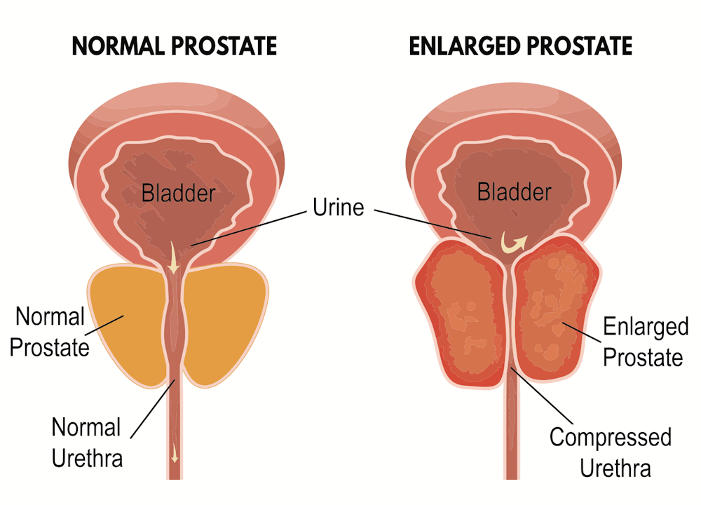 Benign Prostatic Hyperplasia (BPH)   Johns Hopkins Medicine