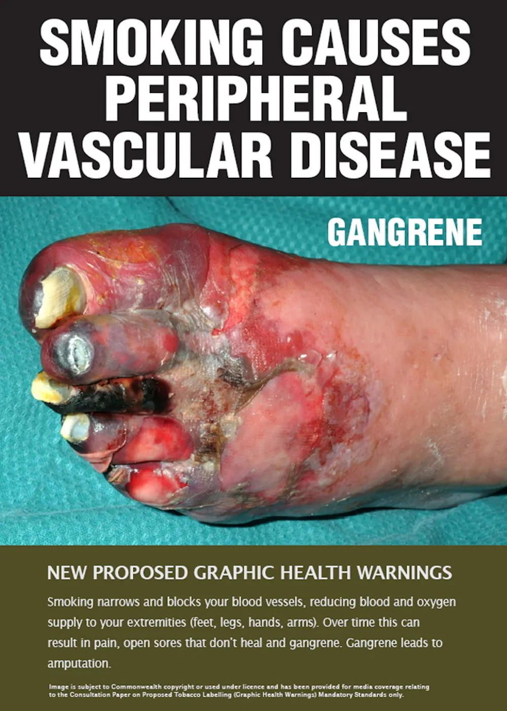 tobacco injuries Health effects of smoking Smoker left with shocking injuries