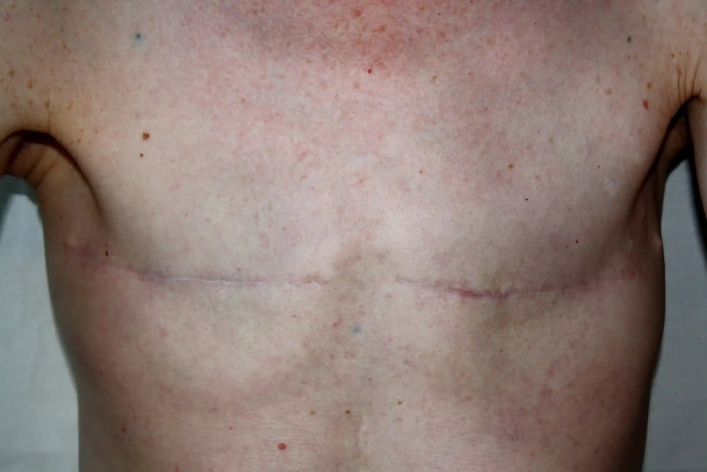Mastectomy Incision Methods More effective and less invasive: how breast cancer treatment has ...