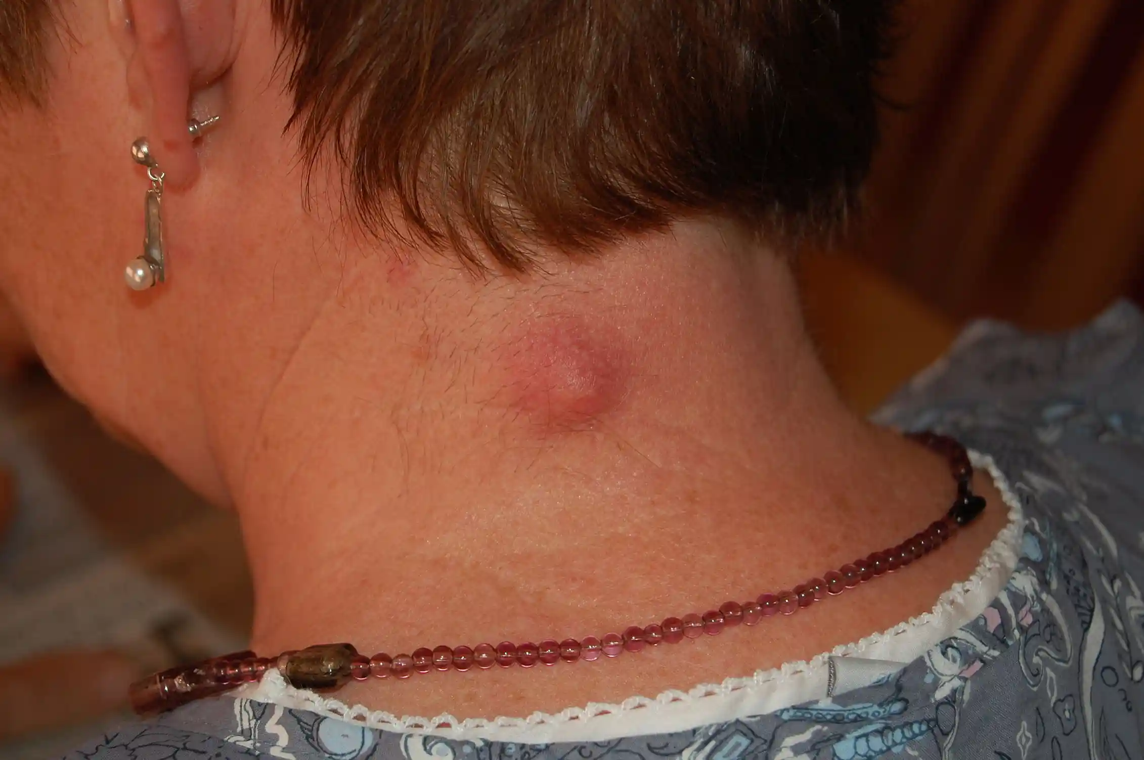 Common lumps and bumps on and under the skin: what are they?