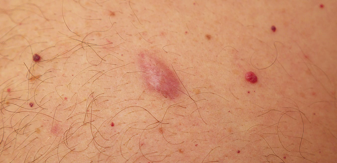 pimple like sores on body
