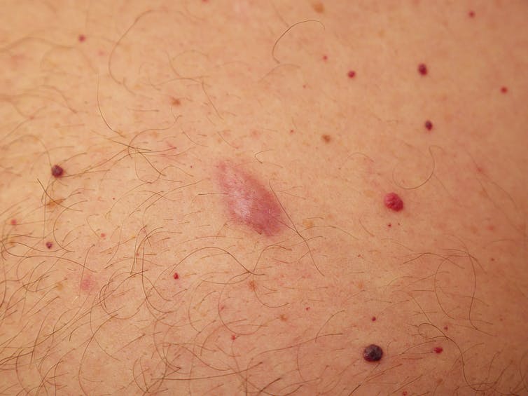 Common lumps and bumps on and under the skin: what are they? - Dermatology  Research Centre - University of Queensland