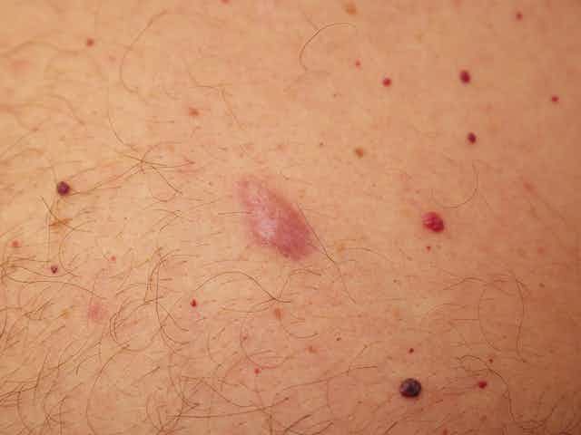 Common lumps and bumps on and under the skin: what are they?