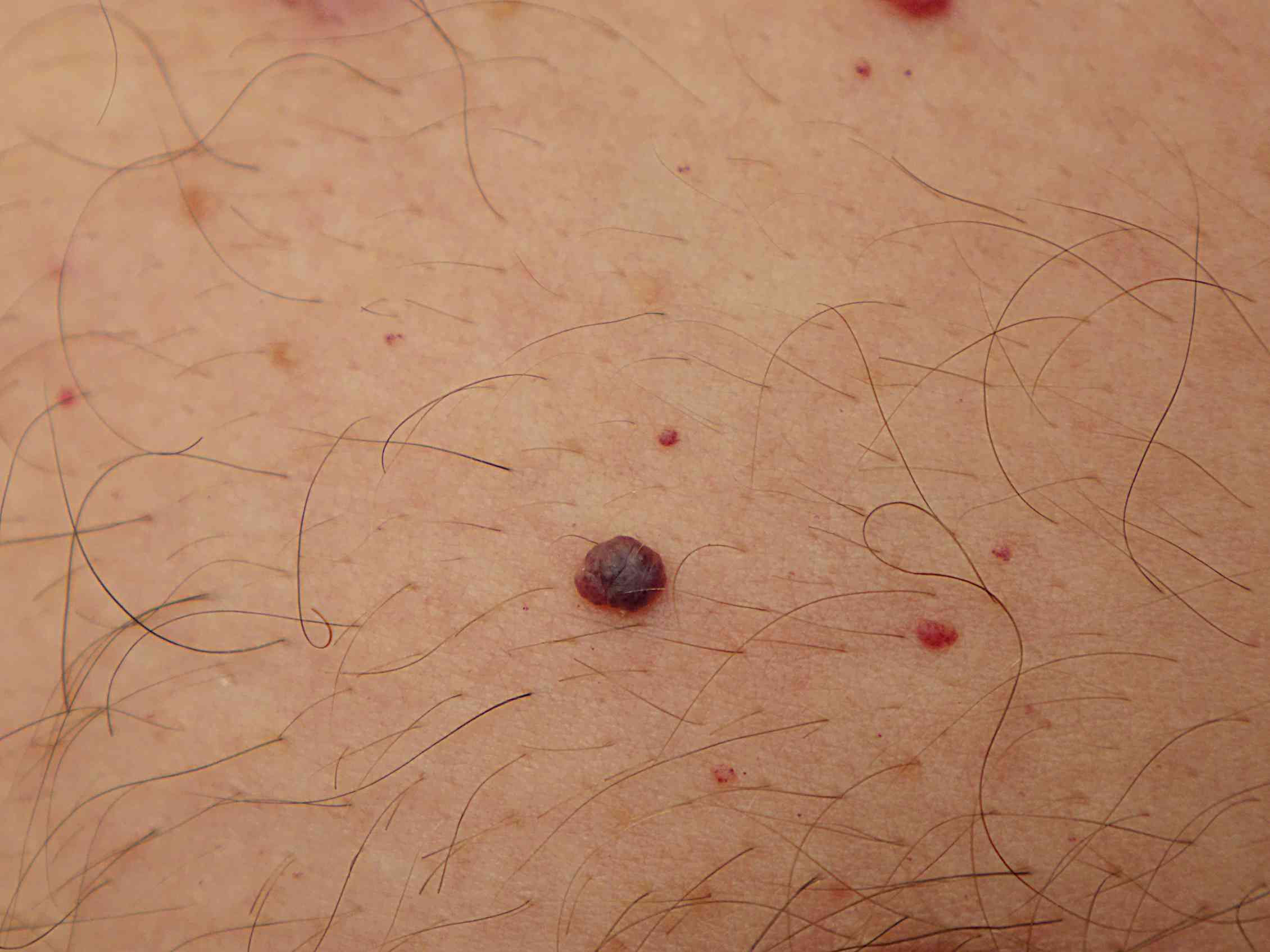 Common Lumps And Bumps On And Under The Skin What Are They