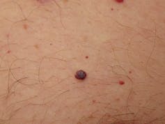 Common lumps and bumps on and under the skin: what are they? - Dermatology  Research Centre - University of Queensland