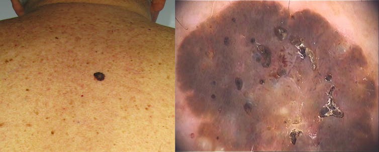 black bumps on skin