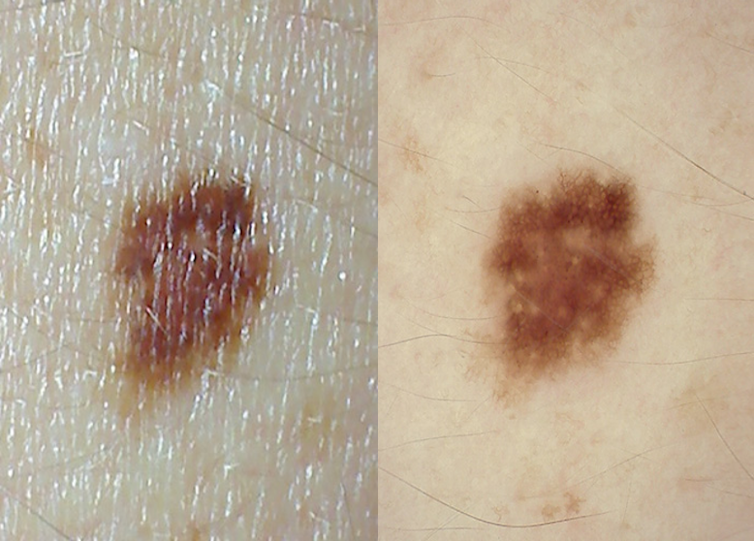 Common Lumps And Bumps On And Under The Skin What Are They Common Lumps And Bumps On And Under The Skin What Are They