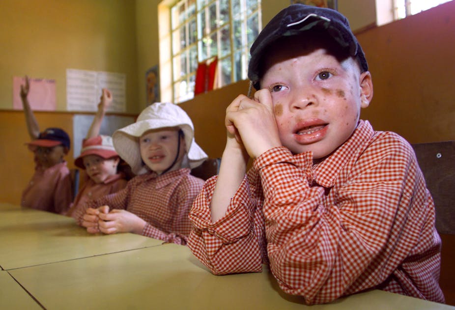 Teachers can do a great deal to help children with albinism thrive