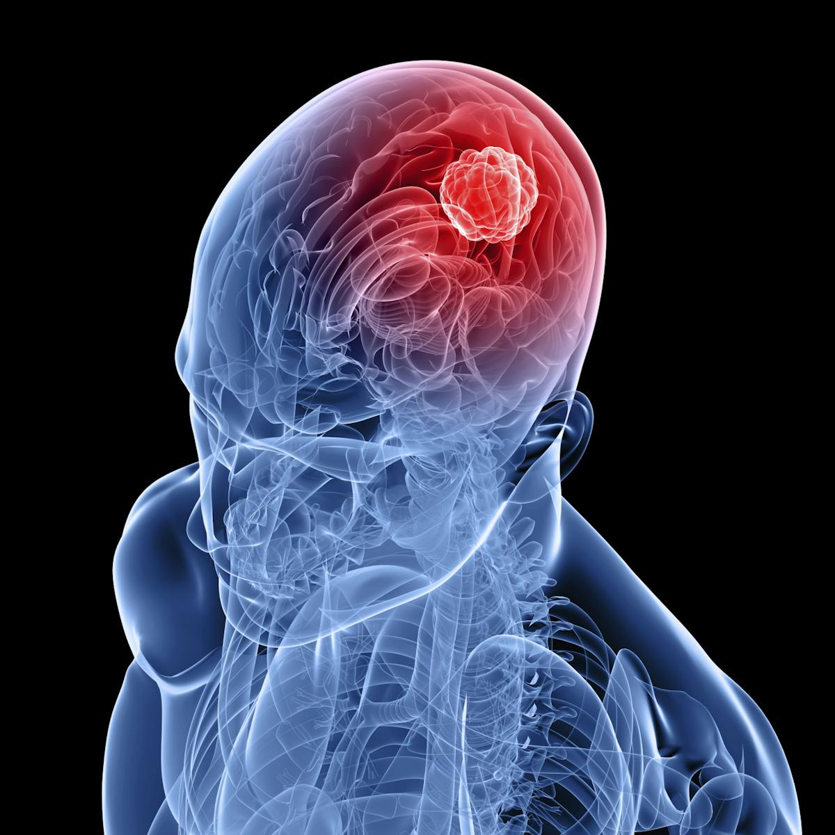 Glioblastoma Why These Brain Cancers Are So Difficult To Treat Glioblastoma Why These Brain Cancers Are So Difficult To Treat