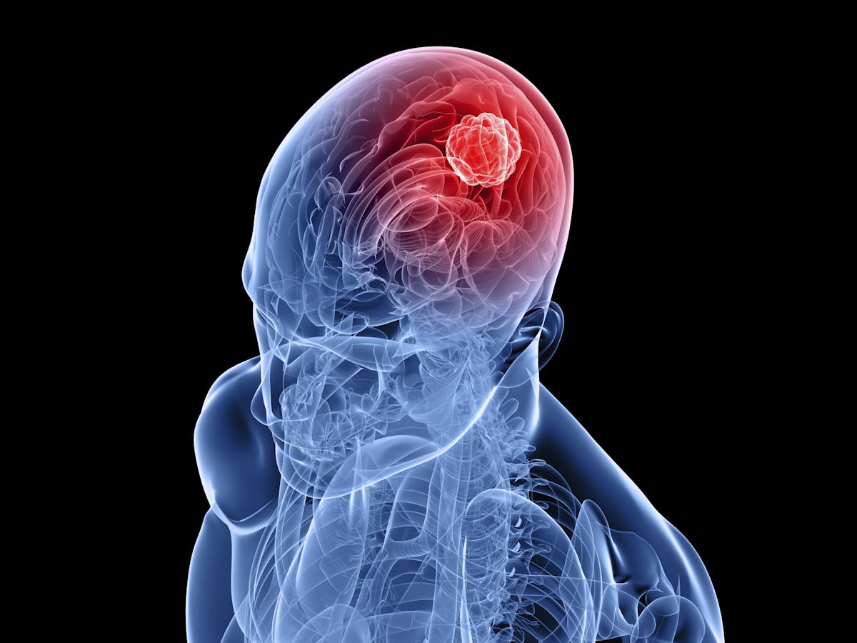 Glioblastoma: why these brain cancers are so difficult to treat