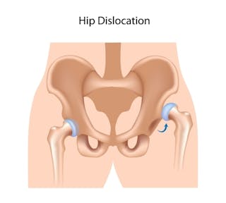 Is Hip Dysplasia In My Newborn Something To Worry About Is Hip Dysplasia In My Newborn Something To Worry About