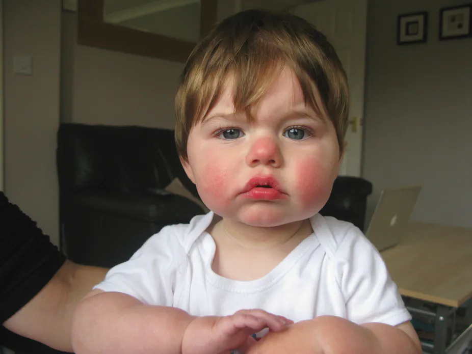 Flushed Cheeks And Pregnancy at Harry Roloff blog
