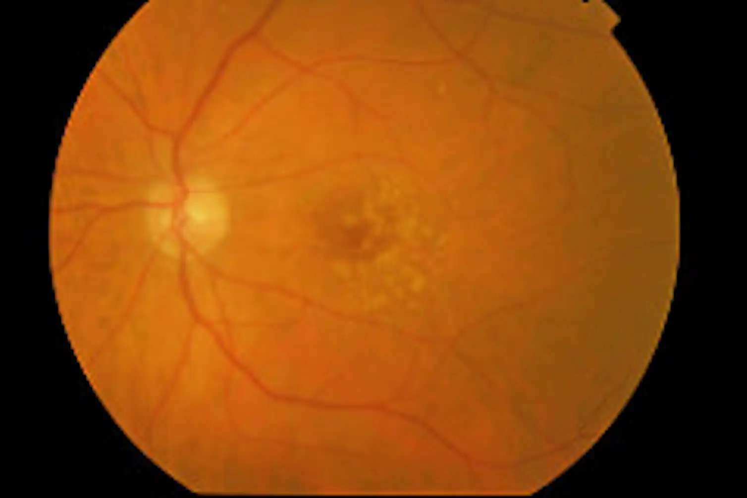 Explainer: what is age-related macular degeneration?