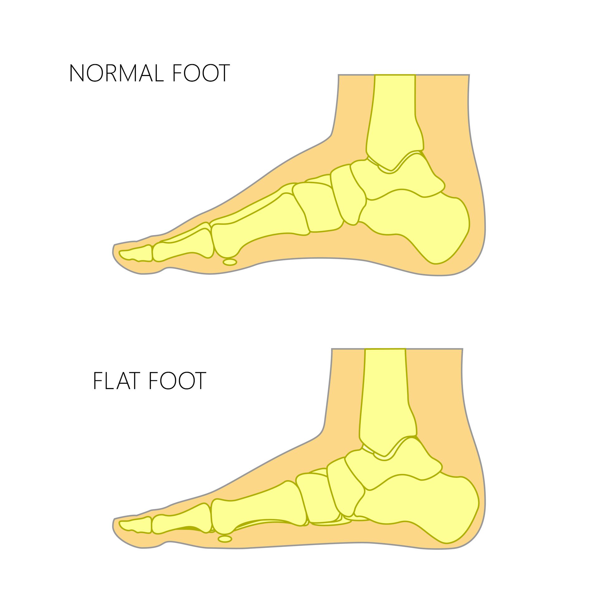 flat feet in 2 year old