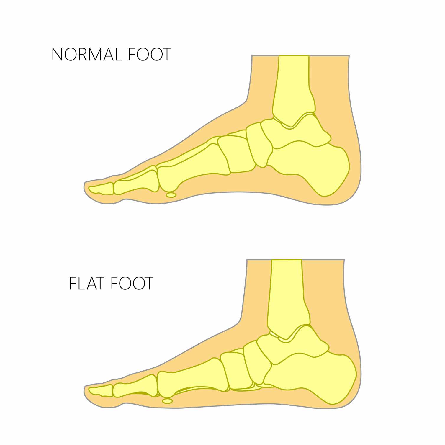Flat Feet In Children What Are They And Should You Be Worried