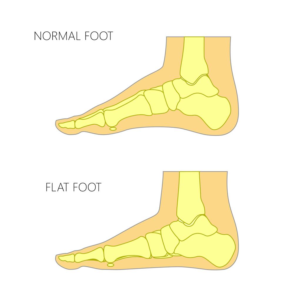 What Are Flat Feet In Children And Are They Something To Worry About What Are Flat Feet In Children And Are They Something To Worry About