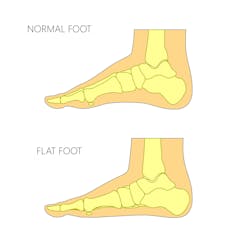 flat feet