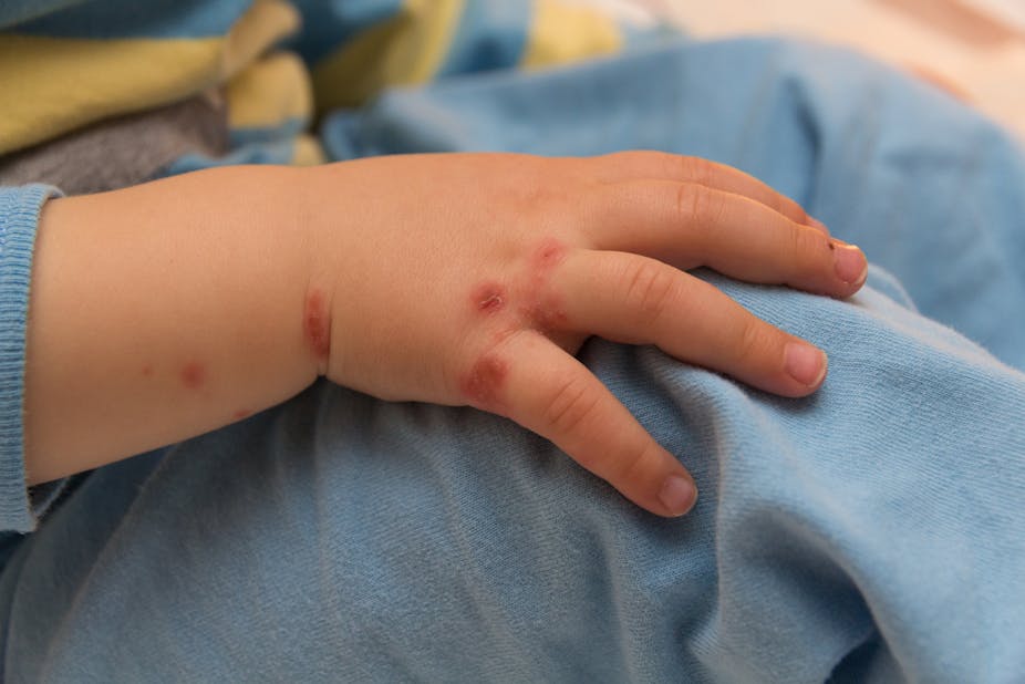 Everything You Need To Know About Chickenpox And Why More Countries Don T Use The Vaccine