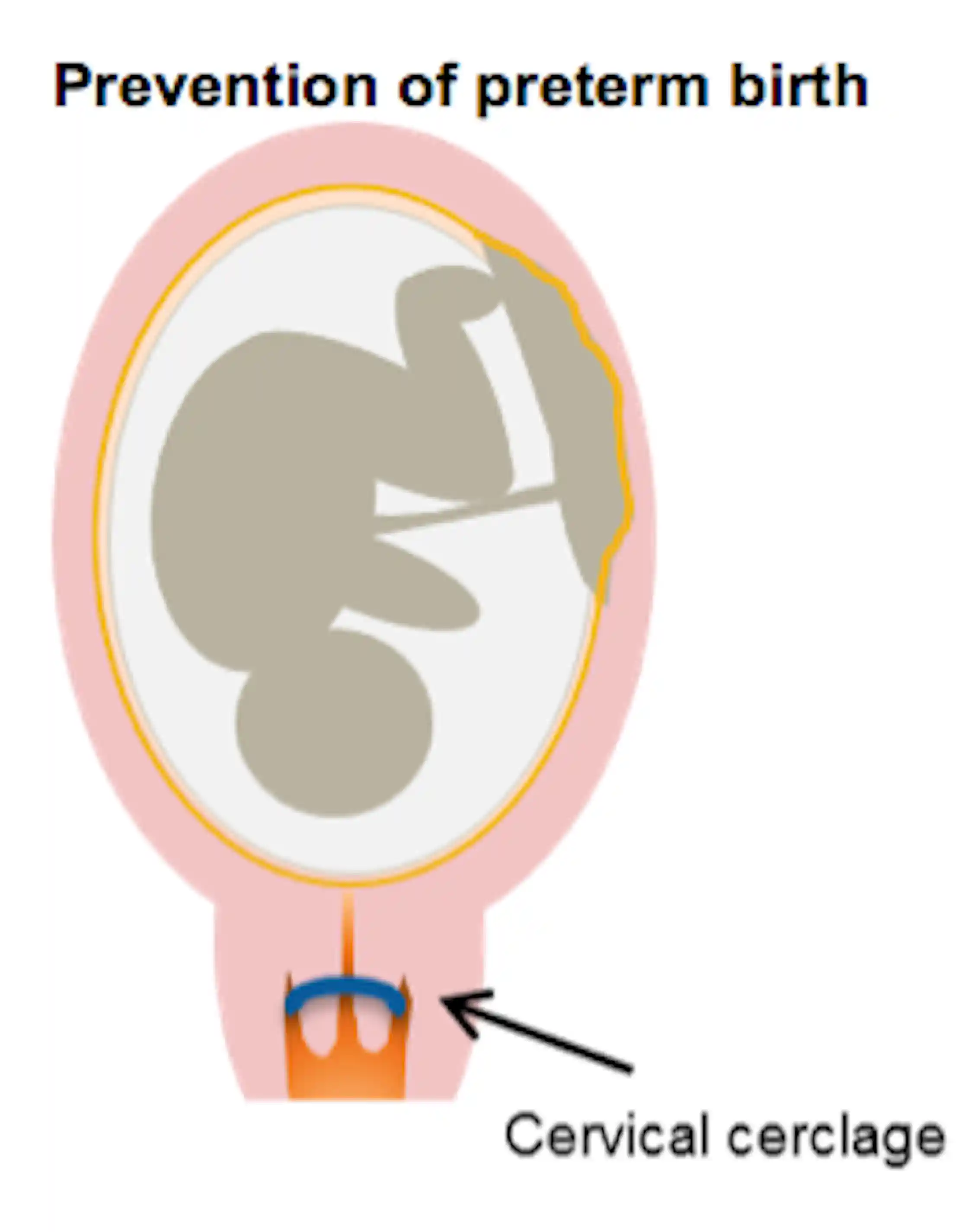 Common method of preventing early births may be causing more