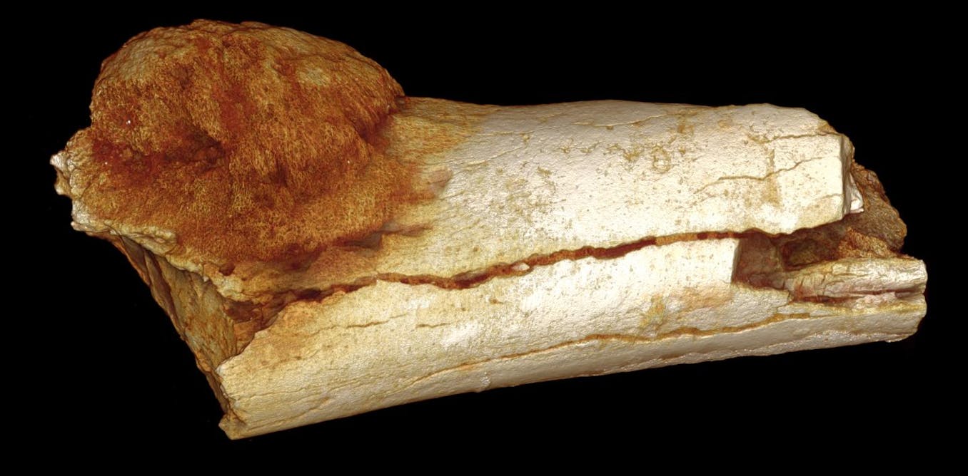 What can a 1.7millionyearold hominid fossil teach us about cancer?