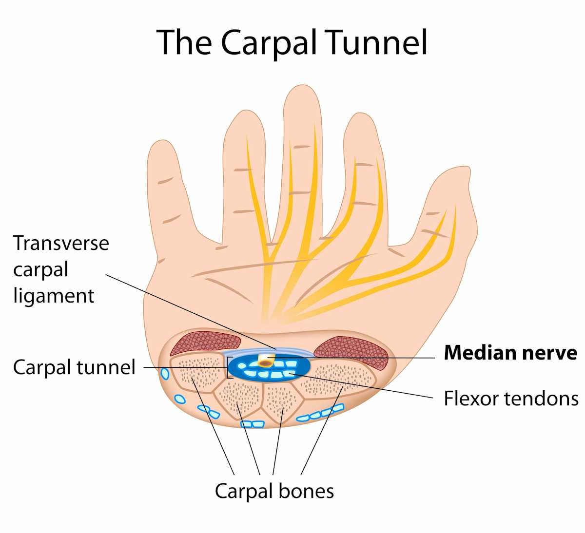 Explainer what is carpal tunnel syndrome and what happens if I get it?