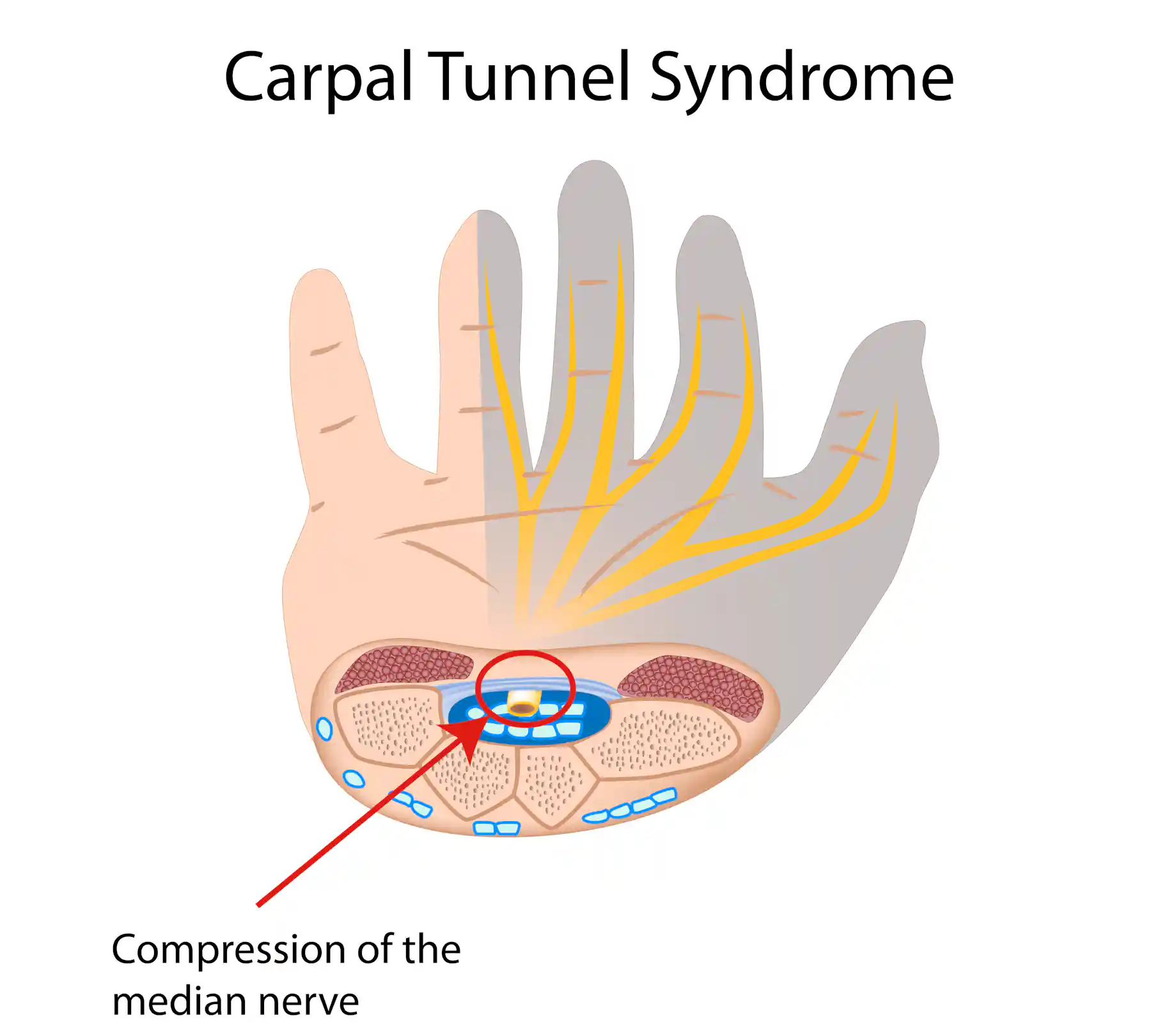 Explainer what is carpal tunnel syndrome and what happens if I get it?