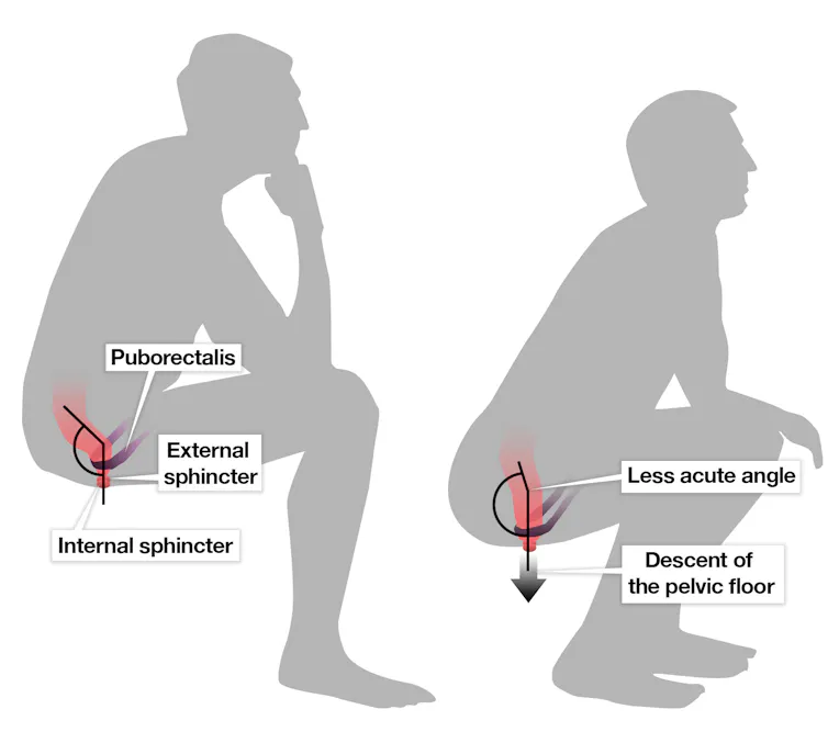 Proper Defecating Form Why You Should Squat To Poop , Best Way to Sit on the Toilet When ...