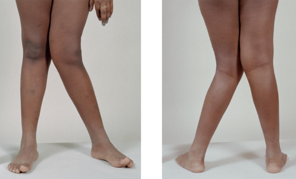 Explainer What Causes Knock Knees And Do They Have To Be Treated Explainer What Causes Knock Knees And Do They Have To Be Treated