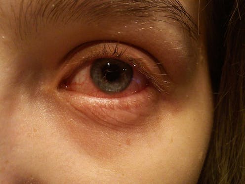 Explainer What Is Conjunctivitis And How Did I Get It