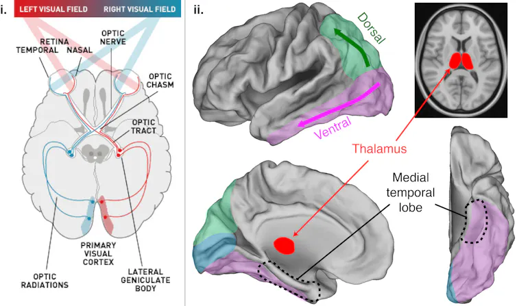 Some people can’t see, but still think they can: here’s how the brain ...