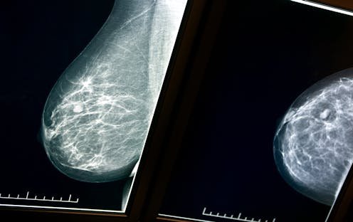 Рубец Сэмба маммография
